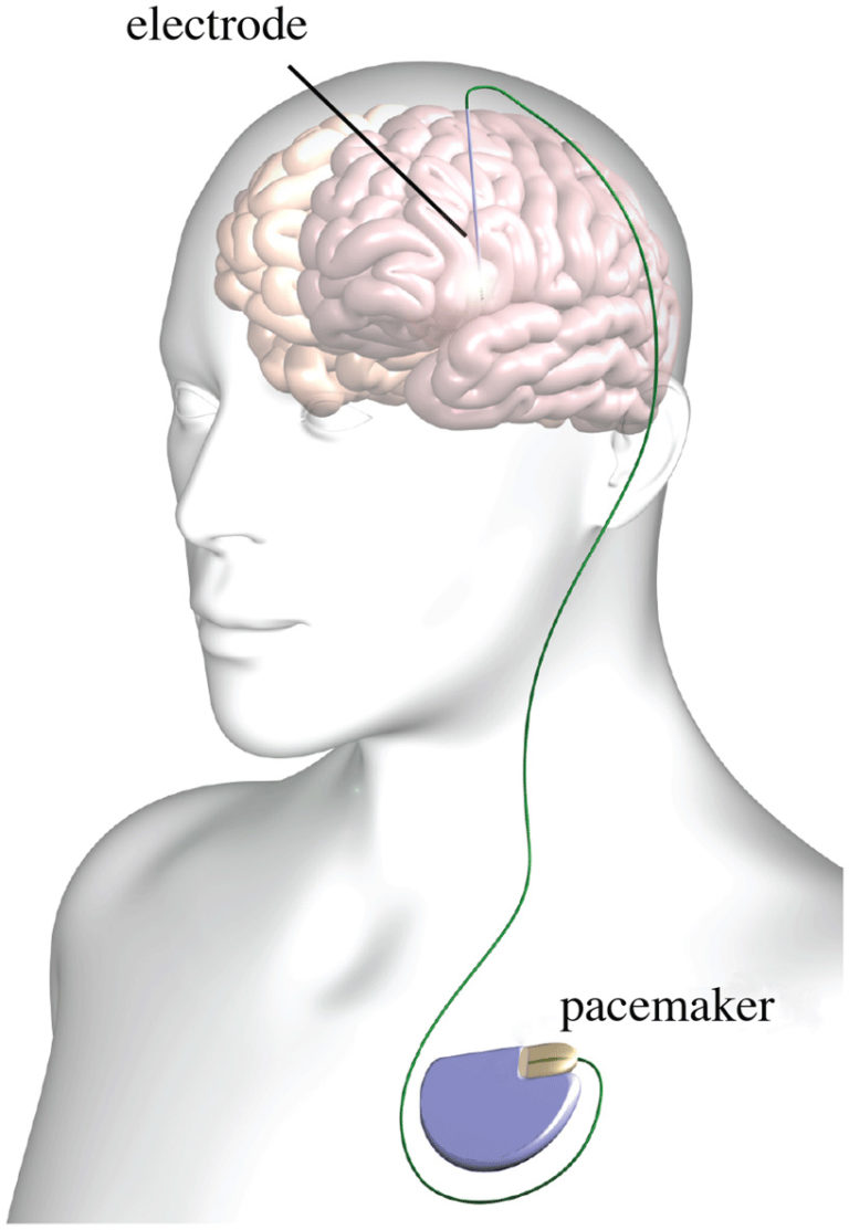 Advanced Therapies For Parkinson’s Disease – Webinar Notes Stanford PD ...