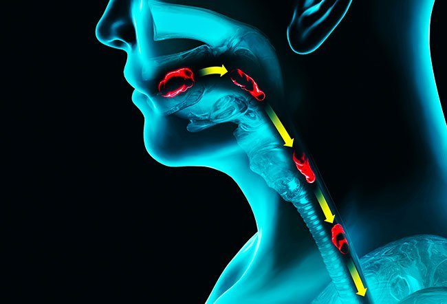 saliva-and-swallowing-challenges-in-parkinson-s-webinar-notes