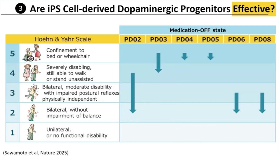 Chart showing Hoehn and Yahr scale scores for six patients in medication-off state, with arrows indicating improvement or worsening from stages 2-5 over two years