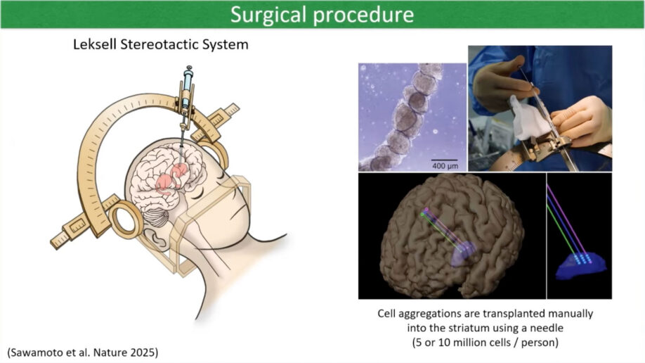 Diagram showing stereotactic frame on patient's head with needle inserting cells into brain, plus microscope images of cell aggregations and needle placement trajectory into striatum